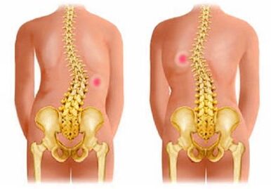 Kurz Diagnostika a kinezioterapie u idiopatické skoliózy u dětí a dospělých