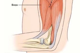 Obnova pohybu lokte u tetraplegiků? Ano, díky chirurgické rekonstrukci