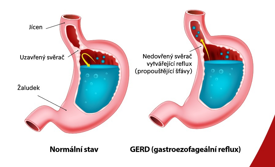 Reflux a kašeľ