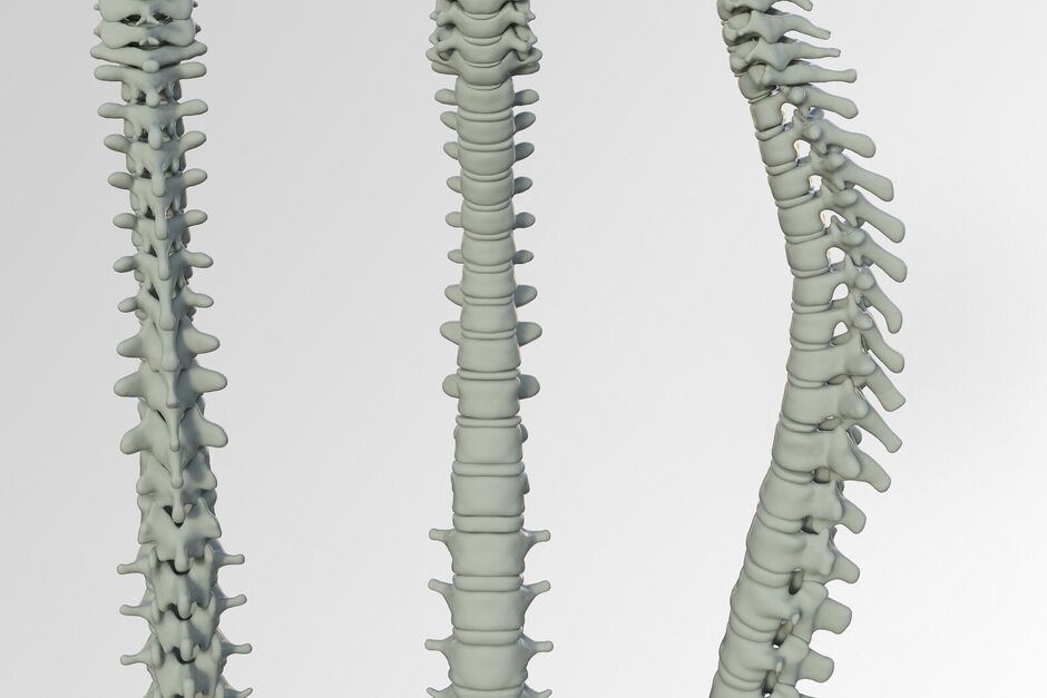 Léčba spasticity baklofenovou pumpou